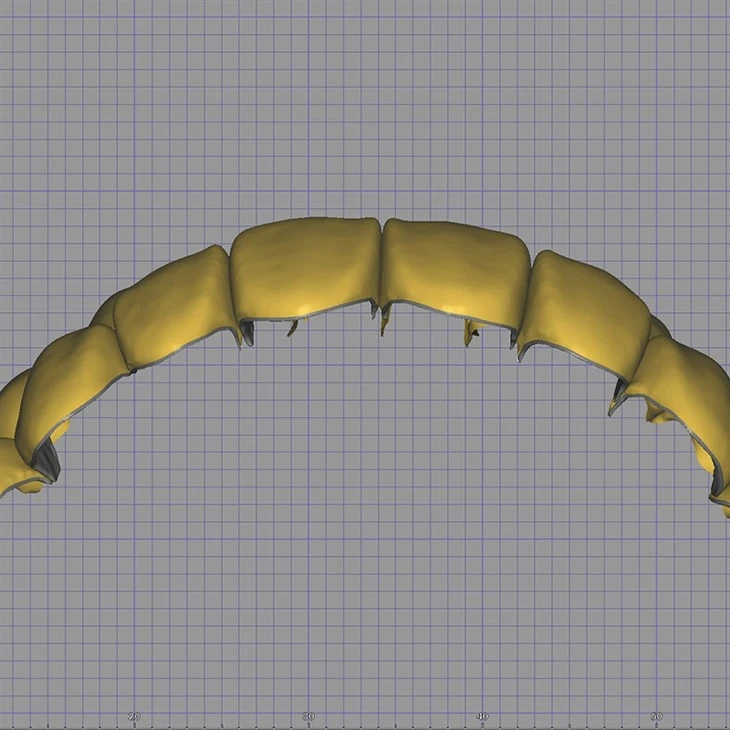 Dental Digital Mutilunit Veneer Design factory
