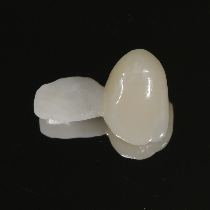Single Zirconium Wing PFZ Maryland Bridge